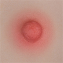 #1 Areola