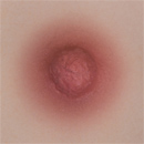 #3 Areola