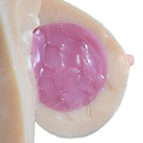 Gel-Filled Breasts