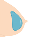Gel-filled Breasts