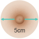 5 cm Breast