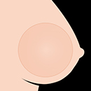 Gel-Filled Breasts