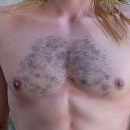 #1 Implanted Chest Hair