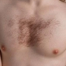 #2 Implanted Chest Hair