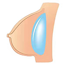 Gel-filled Breasts