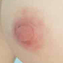 Areola Color Y1