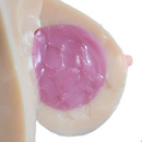 Gel-Filled Breast